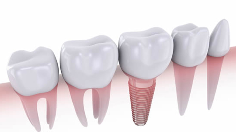Best Questions to Ask a Dental Implantologist Before Implant Treatment